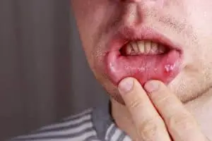 How to Get Rid of Sore in Mouth (With Picture)? cenker sore inside lips