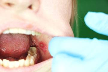 canker sore inside mouth