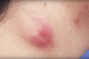 Painful Lump in Armpit Pictures and Remedies Available painful artpit lump photo