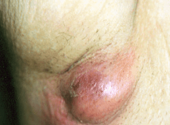 painful lump in armpit causes