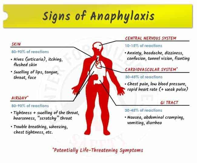 Anaphylaxis signs