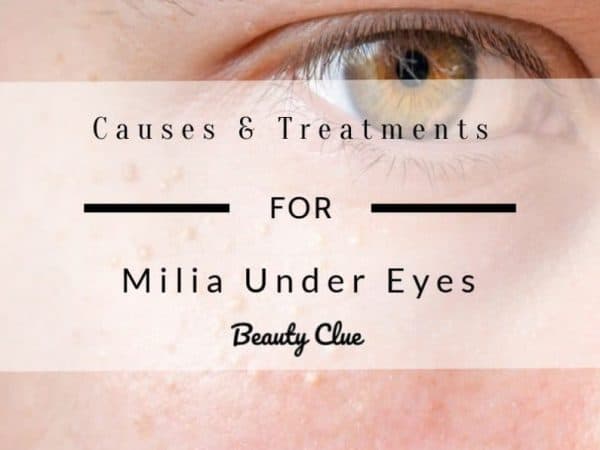 How To Prevent Milia Under Eyes?